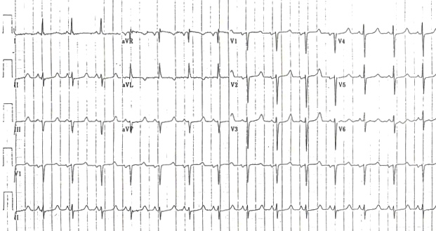 M3 Fig 5 Electrolyte abn -ecg_hypocalcemia_long_qt