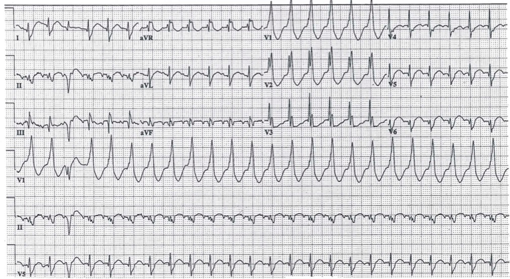M3 Fig 7 Circulation-ventricular-tachycardia