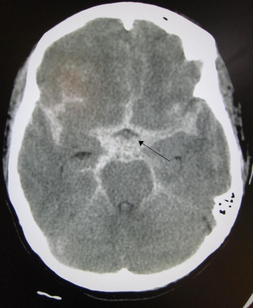 M4 Fig 1 Intracranial Hemorrhage CT