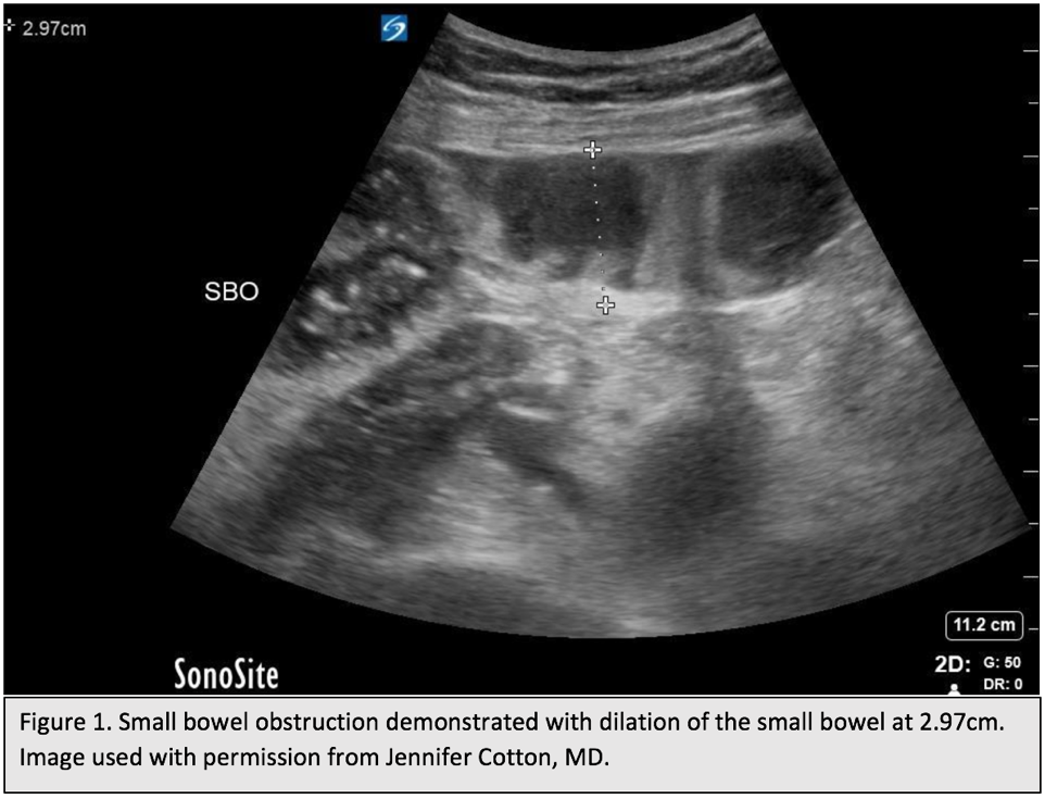 M4 Fig 1 Small Bowell Obstruction