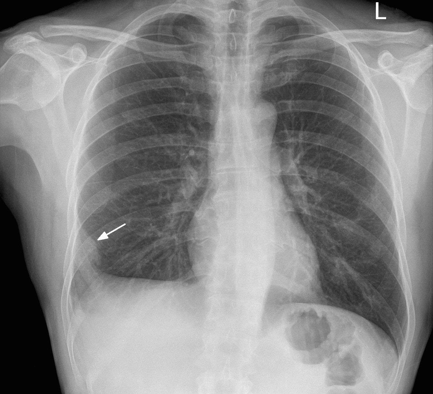M4 Image 1 Pulmonary Embolus