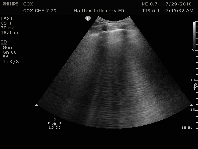 M4 Image 3 Congestive Heart Failure B-lines in right lung field 