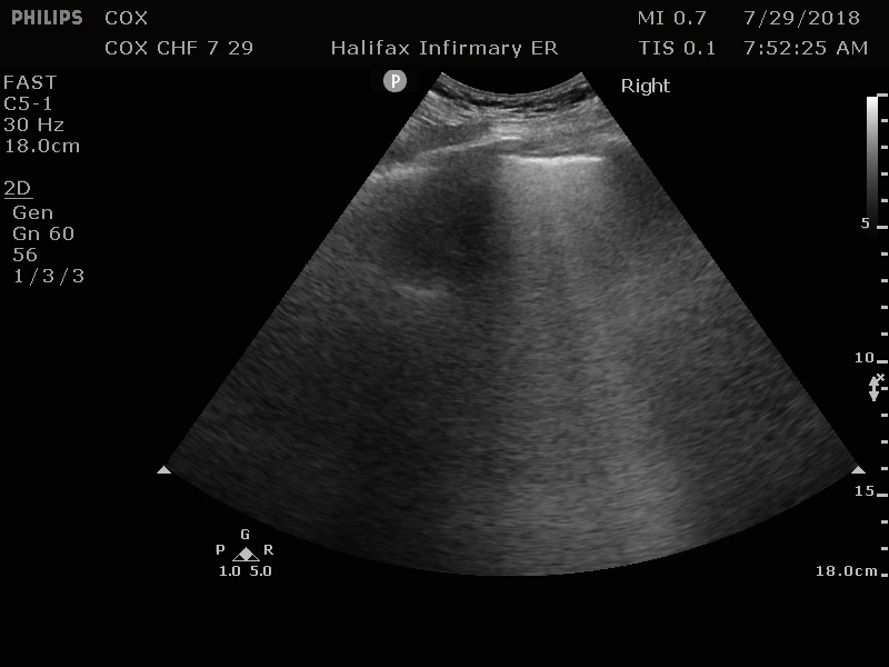 M4 Image 4 Congestive Heart Failure B-lines in left lung