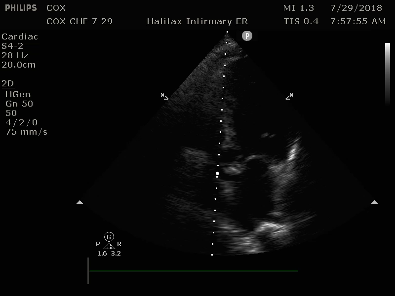 M4 Image 6 Congestive Heart Failure a4C Dilated Left Ventricle