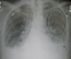 M4 Image 9 Congestive Heart Failure