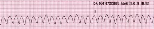 M4 Fig 2 Cardiac Arrest - rhythm strip ECG