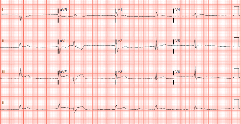 Twelve-lead EKG with 1 mm ST-elevations in leads II, III, aVF, V5, and