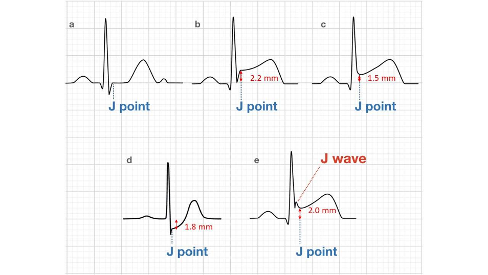 STEMI (ST Elevation Myocardial Infarction): Diagnosis,