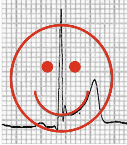 ST Elevation without Infarction - RCEMLearning