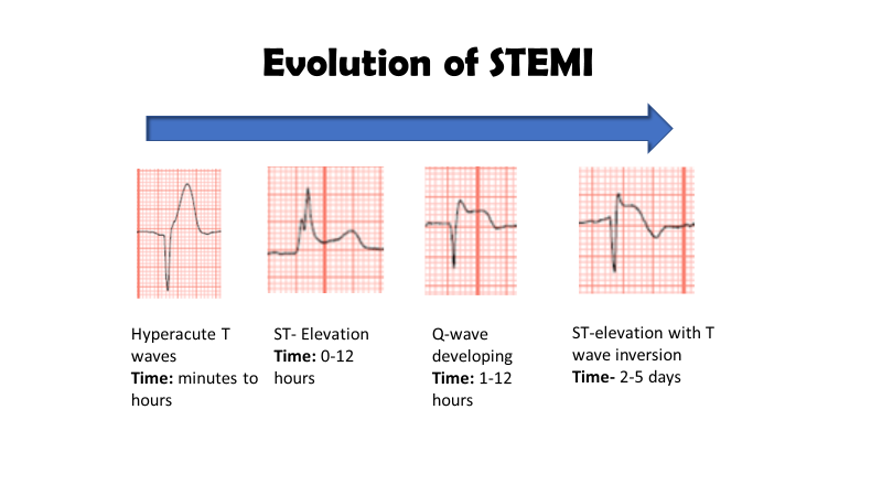 STEMI (ST Elevation Myocardial Infarction): Diagnosis,