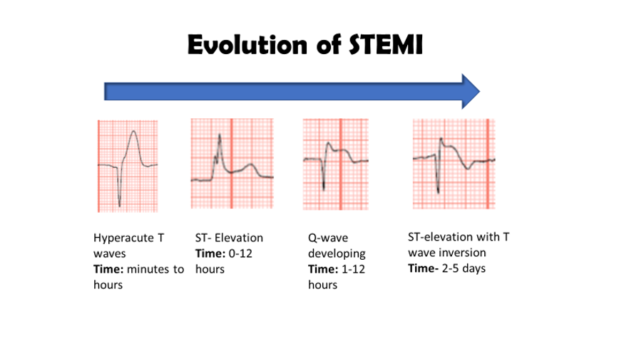 EKG: Early Repolarization vs ST Elevation MI