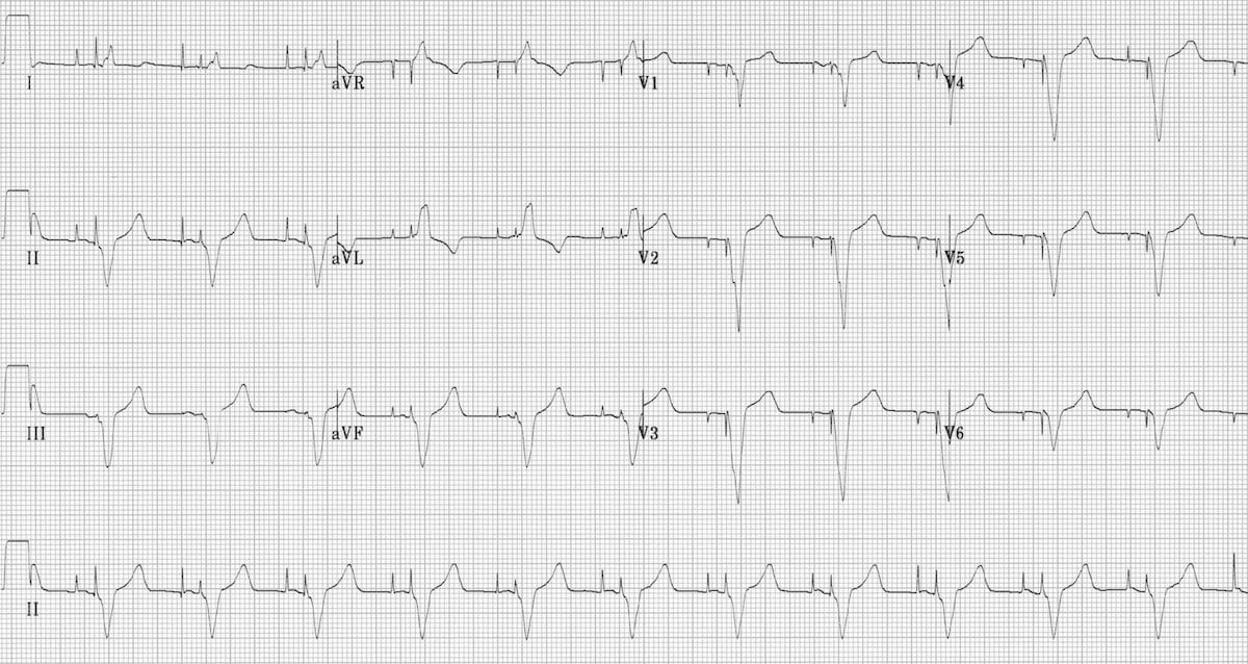 Anterior Wall ST Segment Elevation MI ECG Review