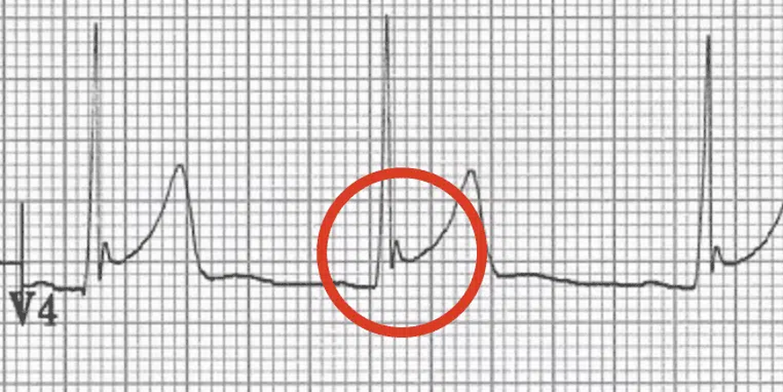 EKG: Early Repolarization vs ST Elevation MI