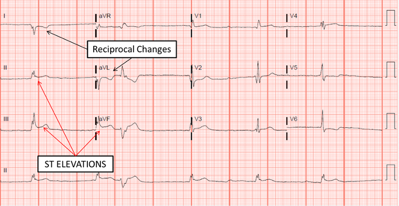 Inferior STEMI. There is > 1mm of ST elevation in leads II, III and