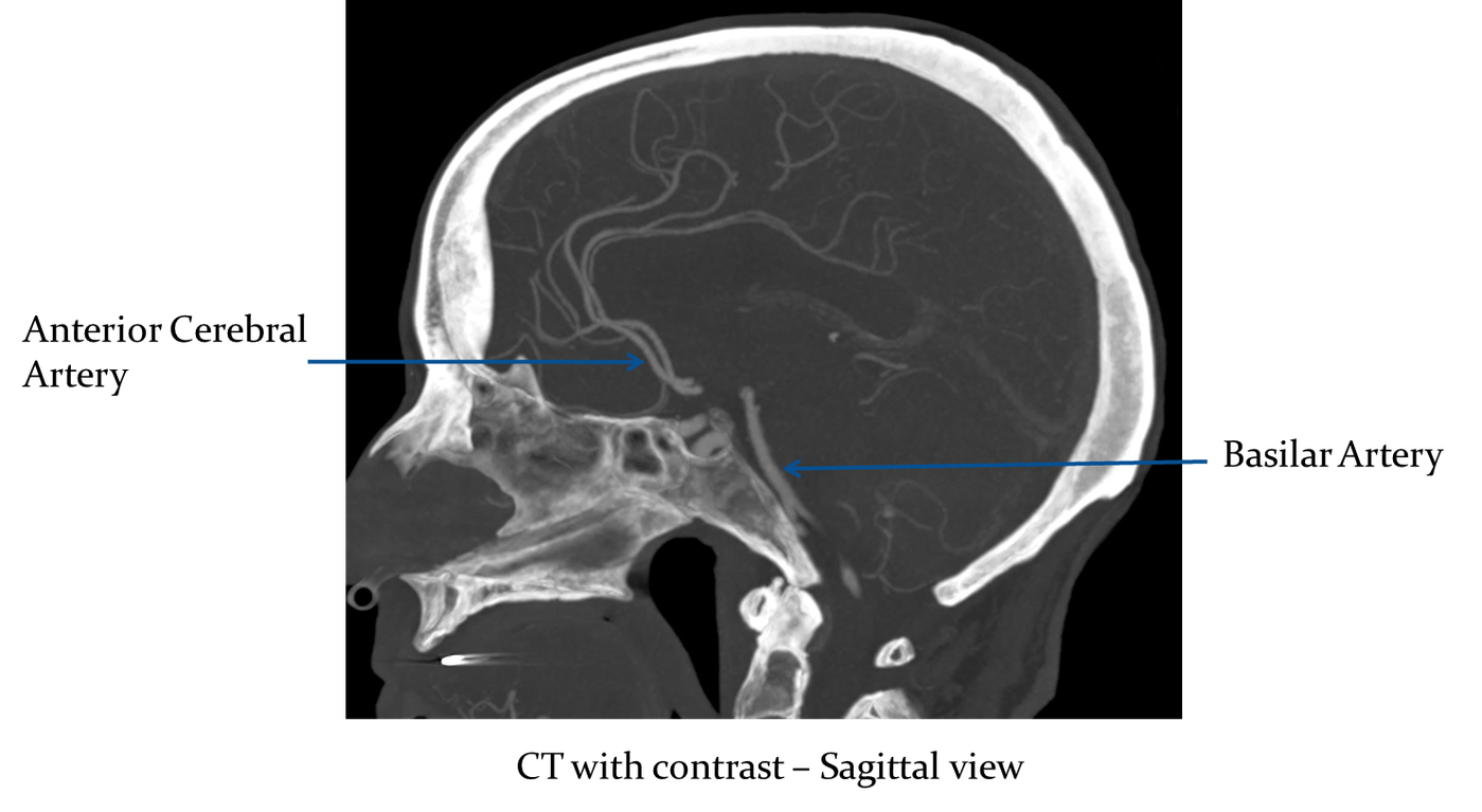 Сагиттальные аномалии. Анатомия мозга кт. Сагиттальная плоскость кт. Базилярная импрессия на кт. Кт головы плоскость.