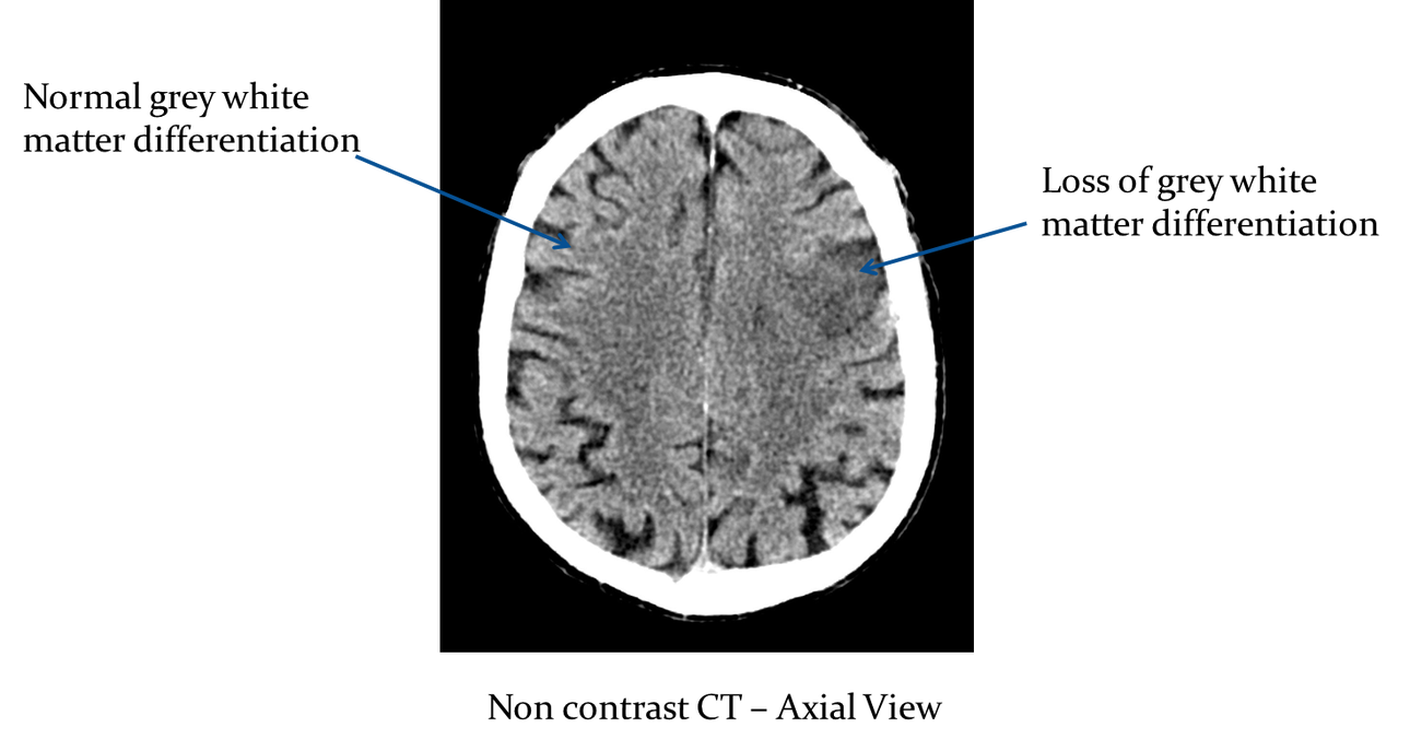 White matter. Грей Уайт 1986. Cerebral ischemia MRI. Gray matter loss adolescent MRI. White matter Vanishing.