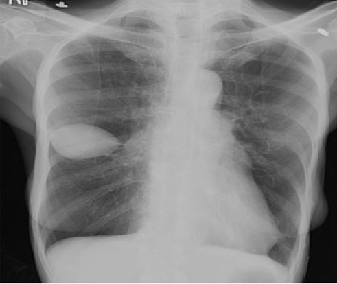 Chest Radiograph