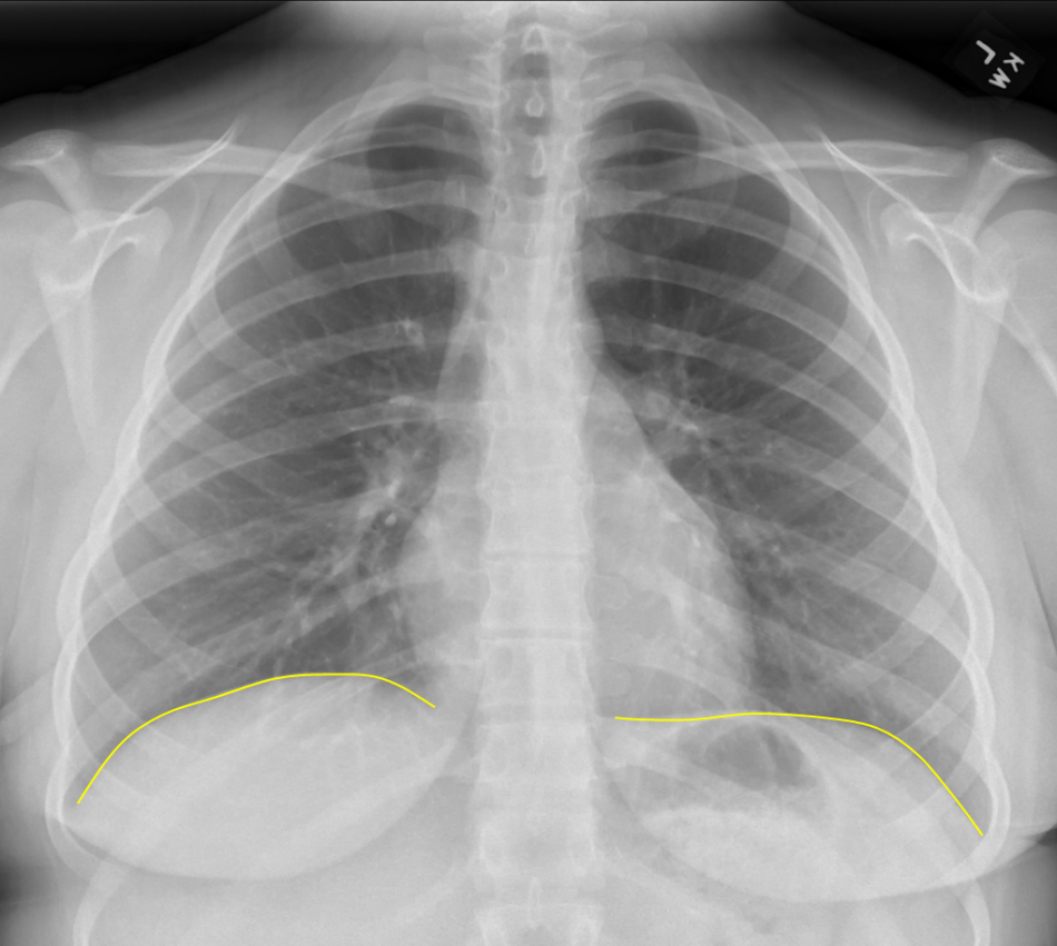 Chest Radiograph