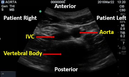 abdominal aorta ultrasound