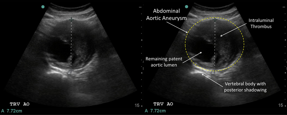 Aortic Dissection Ultrasound