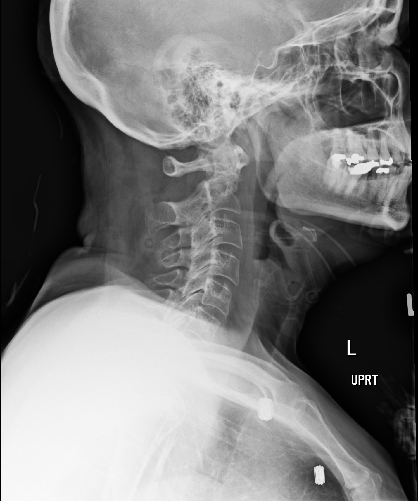 cervical spine fracture x rays