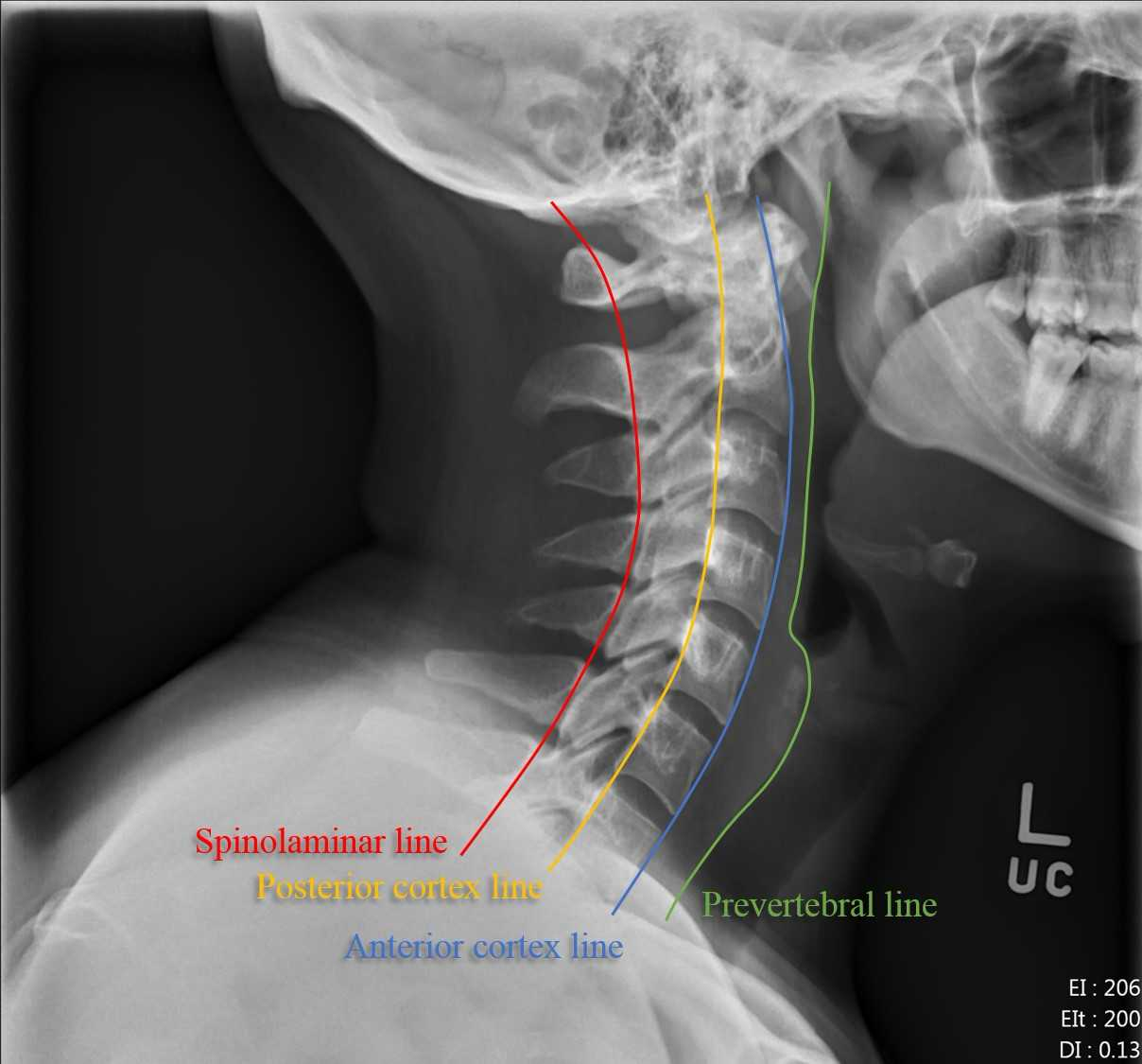 x ray of the cervical spine