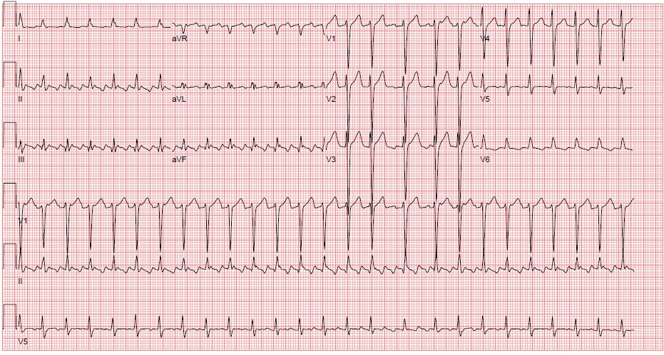 atrial flutter 2 to 1 vs 4 to 1