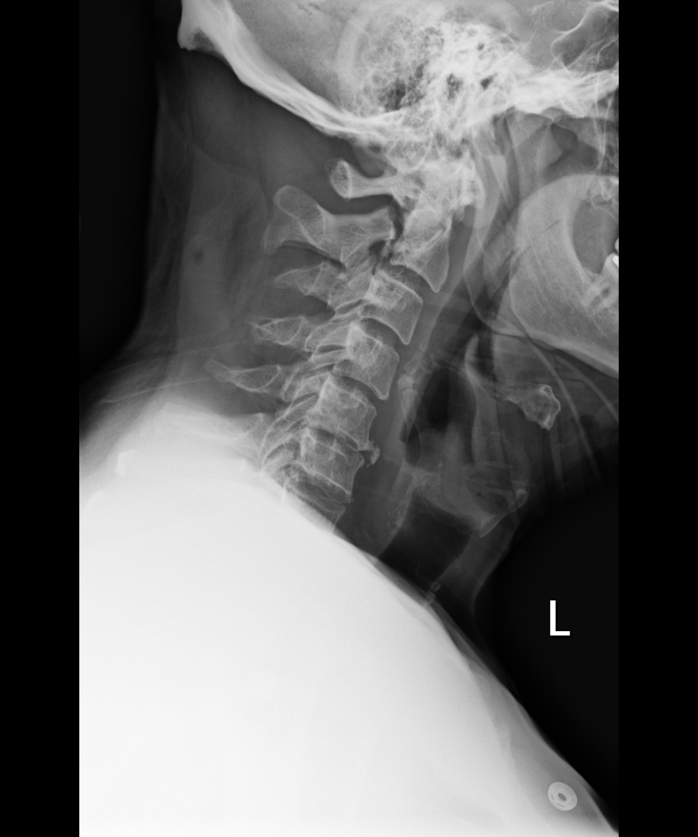 x ray of right lateral cervical spine