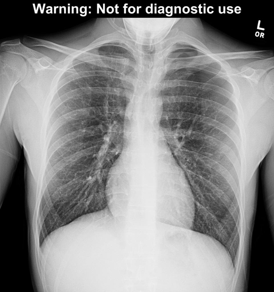 Pneumothorax