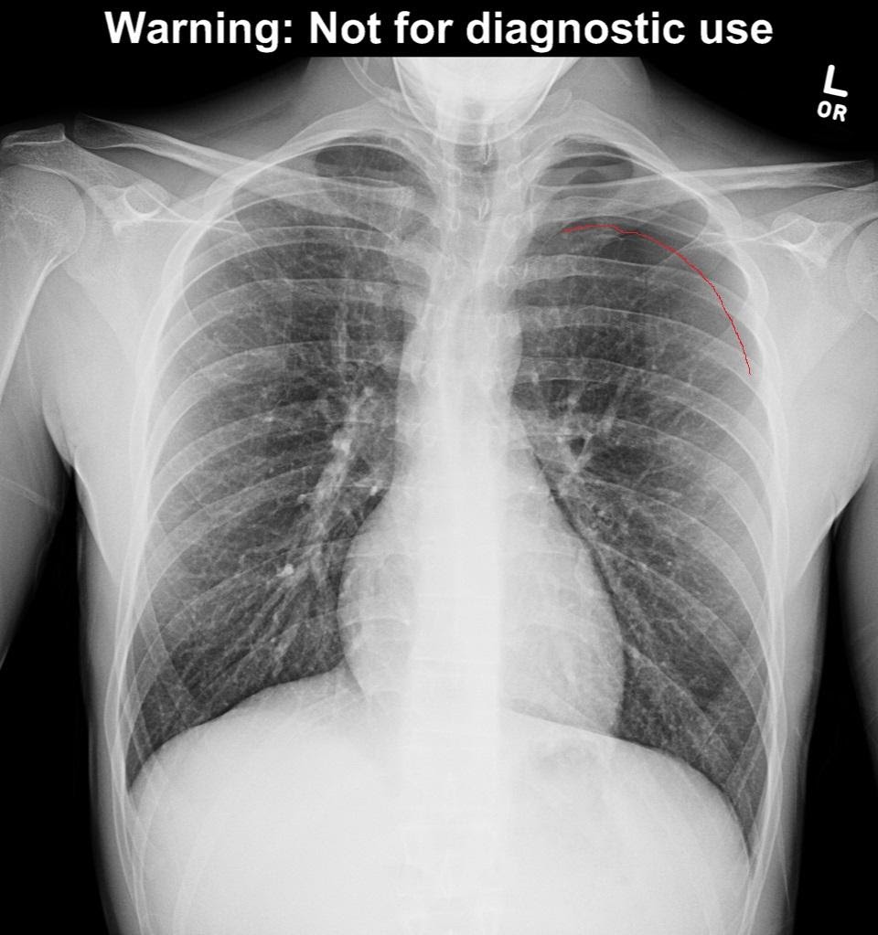 tracheal deviation tension pneumothorax