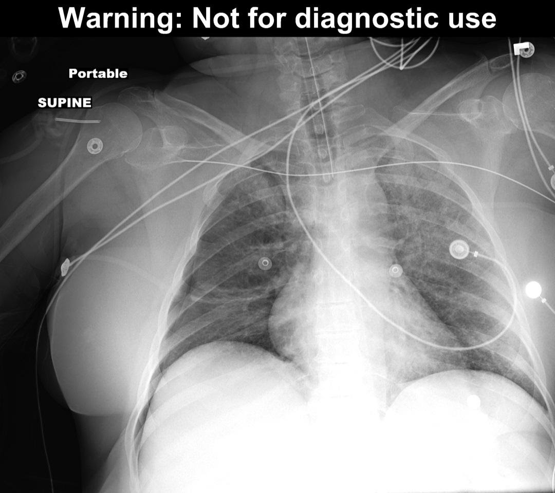 Figure 2 – Deep Sulcus Sign due to right pneumothorax.
