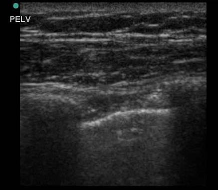 Figure 3 Pneumothorax– ultrasound of the anterior chest wall using a linear probe