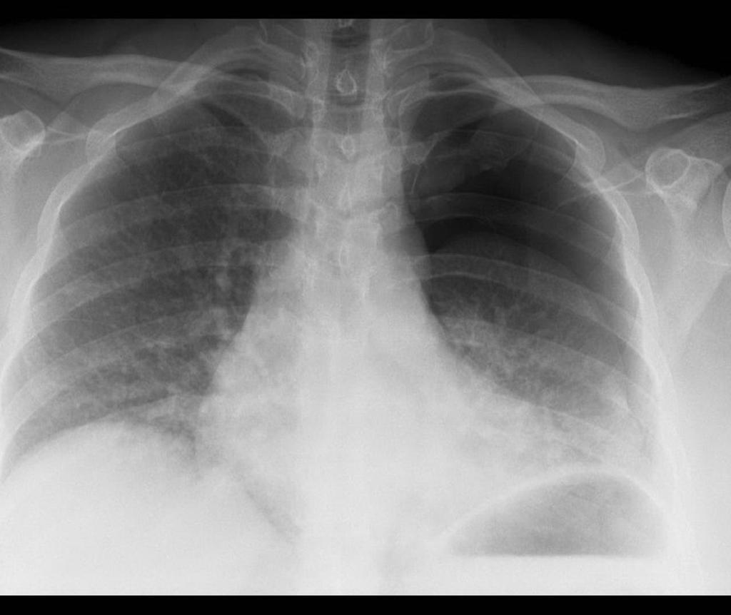 M4 Fig 1 Chest Trauma - Simple traumatic left sided pneumothorax