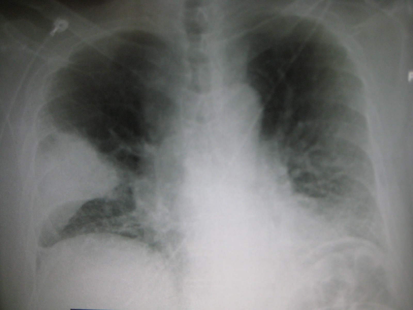 M4 Fig 1 Pneumonia Xray