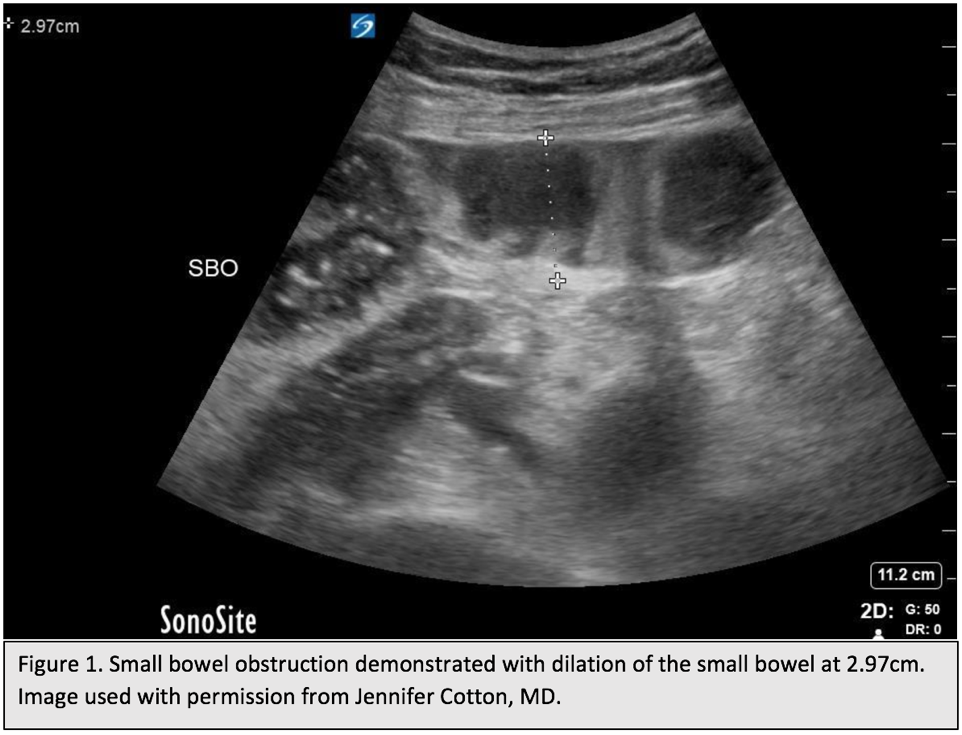 Small Bowel Obstruction