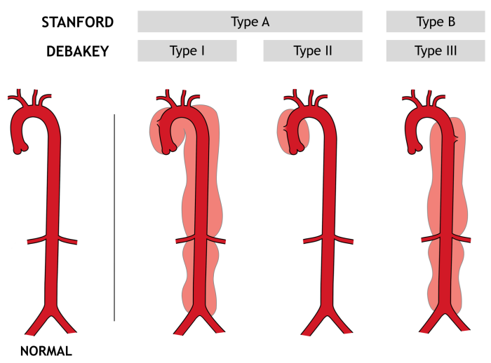 aortic dissection blood pressure arms