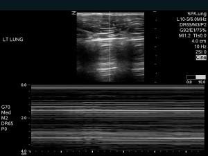 M4 Fig 1b Chest Trauma - Ultrasound image pneumothorax