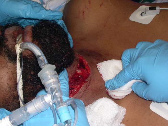 M4 Fig 2 Neck Trauma - Self-inflicted knife laceration to neck