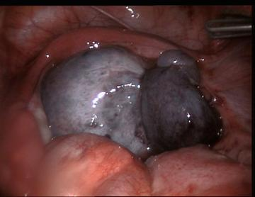Laparoscopic Oophorectomy for Ovarian Torsion • Video •