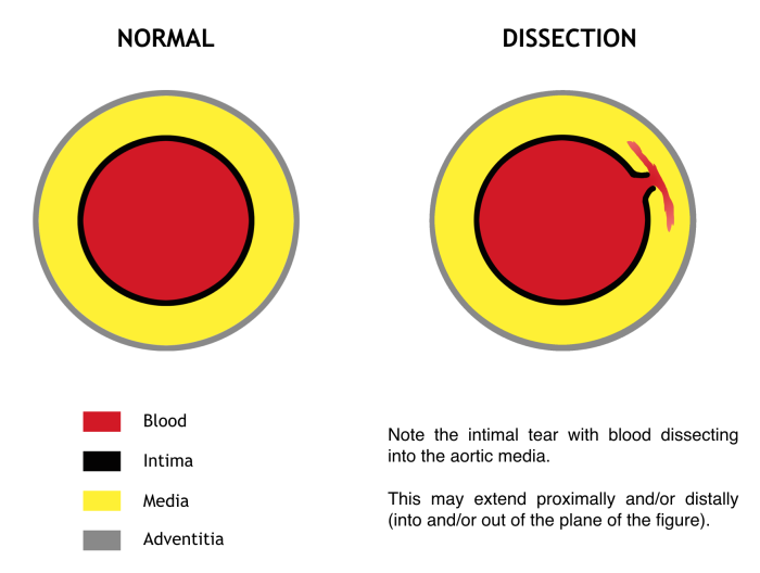 aortic dissection cross section