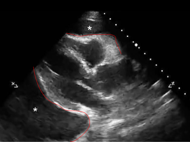M4 Fig 4 Chest Trauma - Pericardial Tamponade on bedside eFAST exam