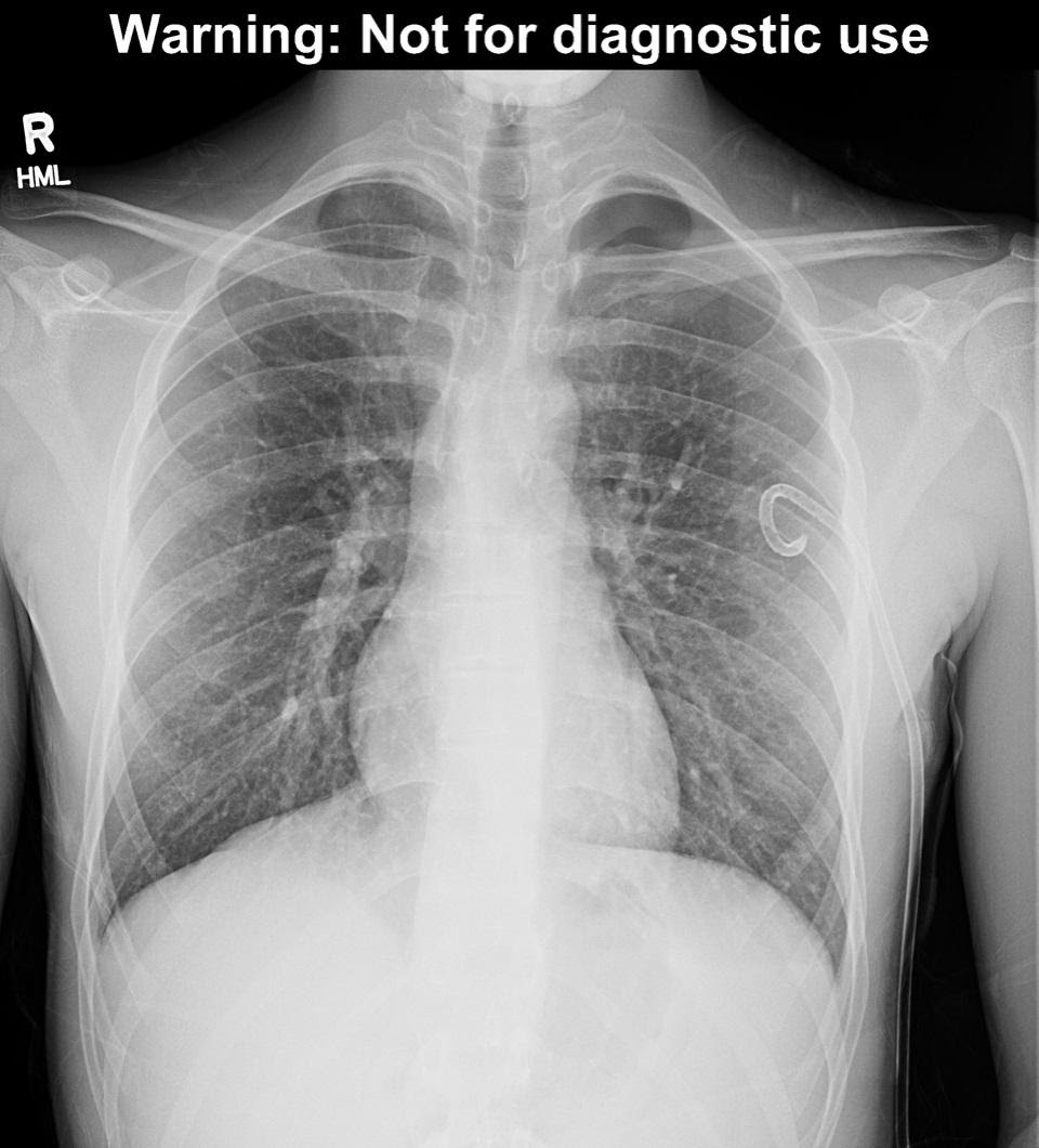 M4 Fig 7 Pneumothorax– Pigtail catheter placement.