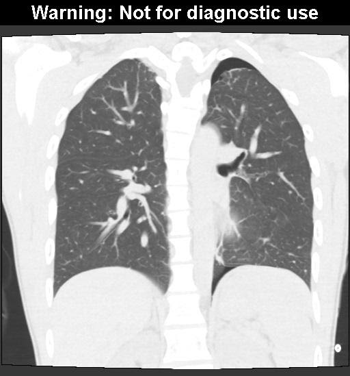 M4 Figure 5 – Pneumothorax as seen on CT