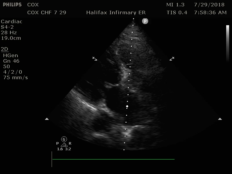M4 Image 5 Congestive Heart Failure PSL, Dilated Left Ventricle