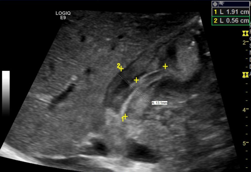 pyloric stenosis ultrasound protocol
