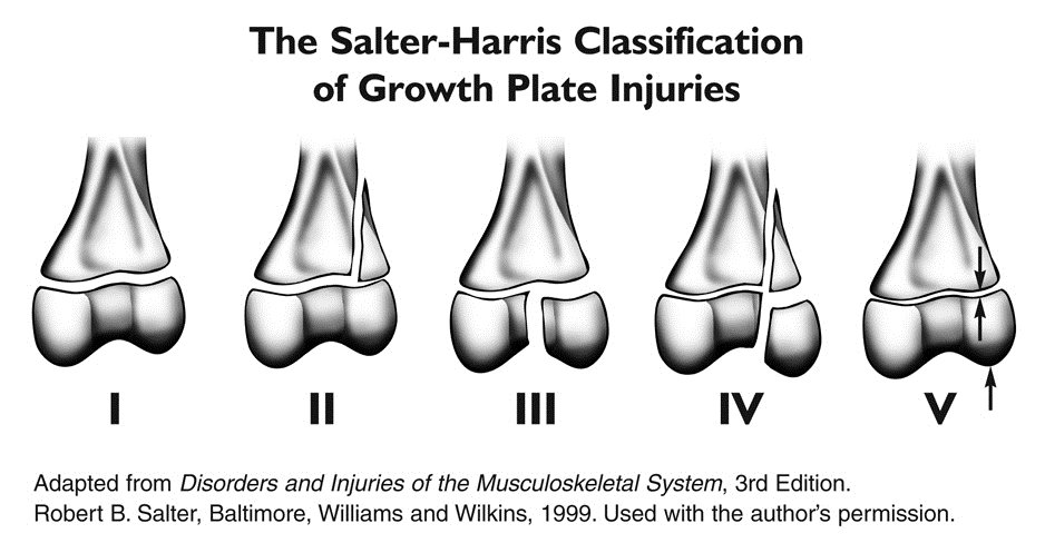 Peds Fig 3 Fractures -growth-plate-injuries